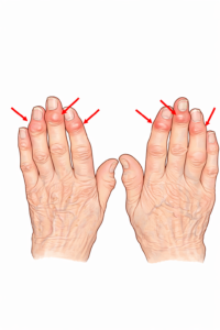 指の変形ーヘバーデン結節？リウマチ？